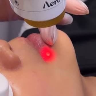 Lip Plumping (4 session package) at SkinUpgradeMD in Charlotte, NC