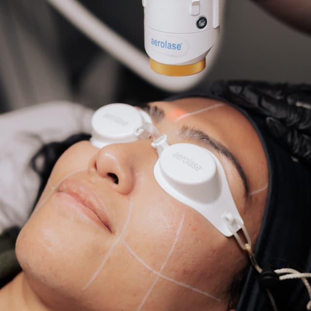 Forhead (4 session laser package) at SkinUpgradeMD in Charlotte, NC